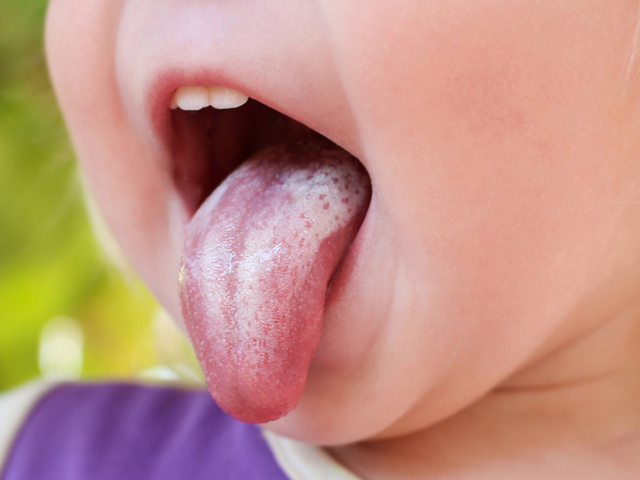 Температура у ребенка и запах изо рта налет на языке